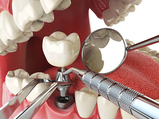 Best Emergency Dentist for Lost Fillings or Crowns in Ocean Acres, NJ